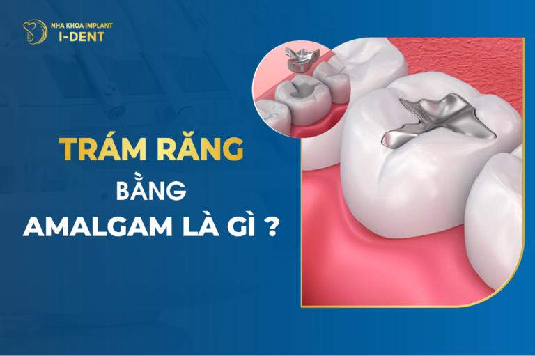 Trám Răng Bằng Amalgam Là Gì