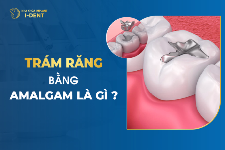 Trám Răng Bằng Amalgam Là Gì