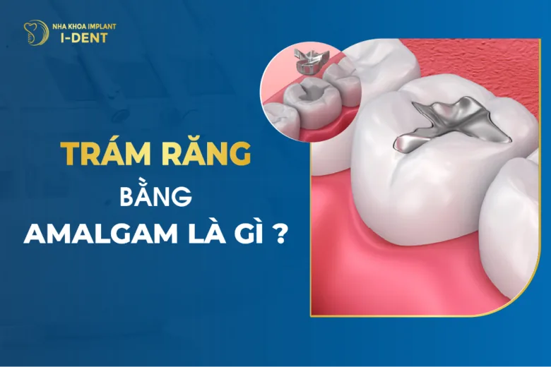 Trám Răng Bằng Amalgam Là Gì