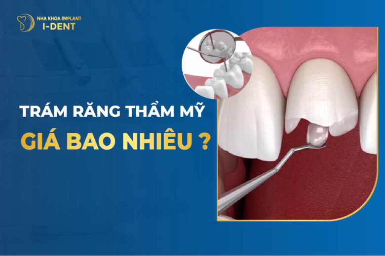 Trám Răng Giá Bao Nhiêu? Bảng Giá Trám Răng