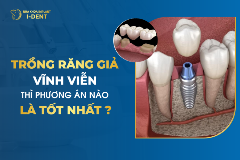 Trồng Răng Giả Vĩnh Viễn Thì Phương Pháp Nào Là Tốt Nhất?