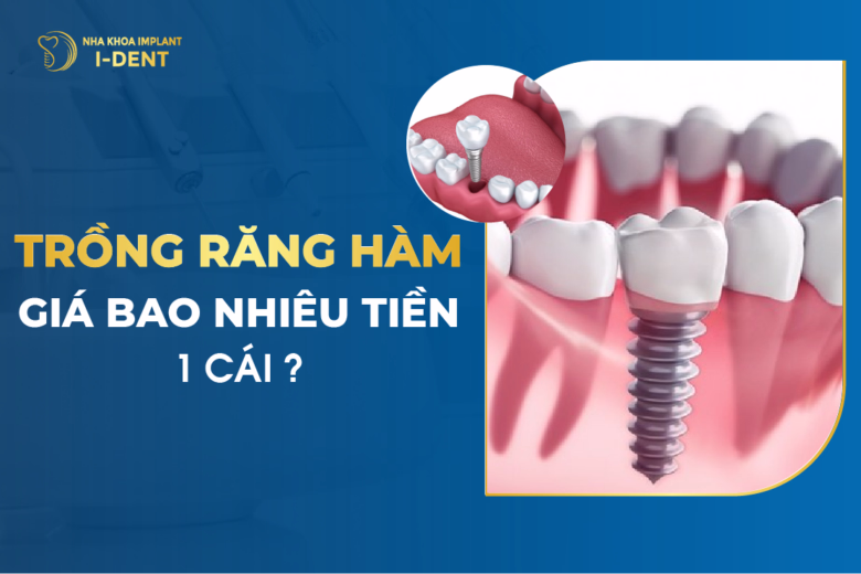 trồng răng giá bao nhiêu