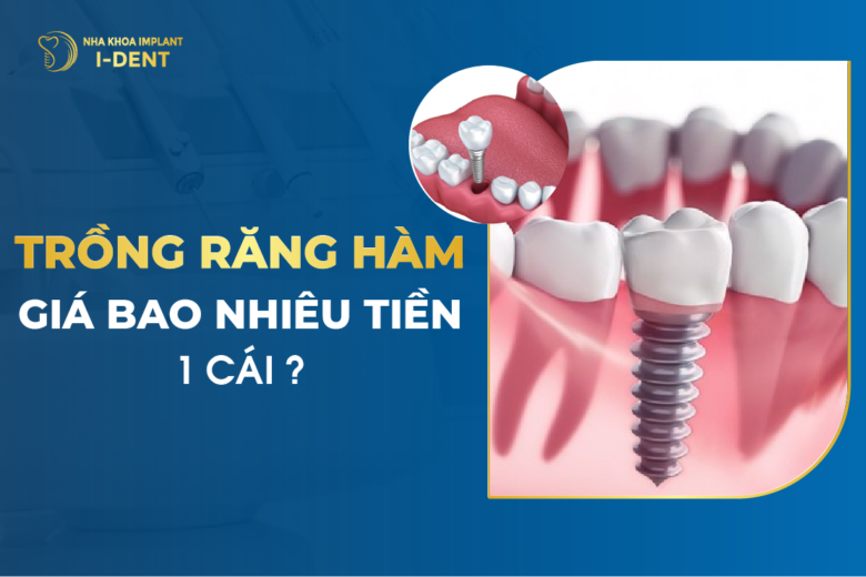 Trồng Răng Hàm Giá Bao Nhiêu Tiền 1 Cái?