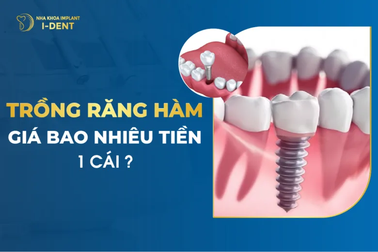 trồng răng giá bao nhiêu