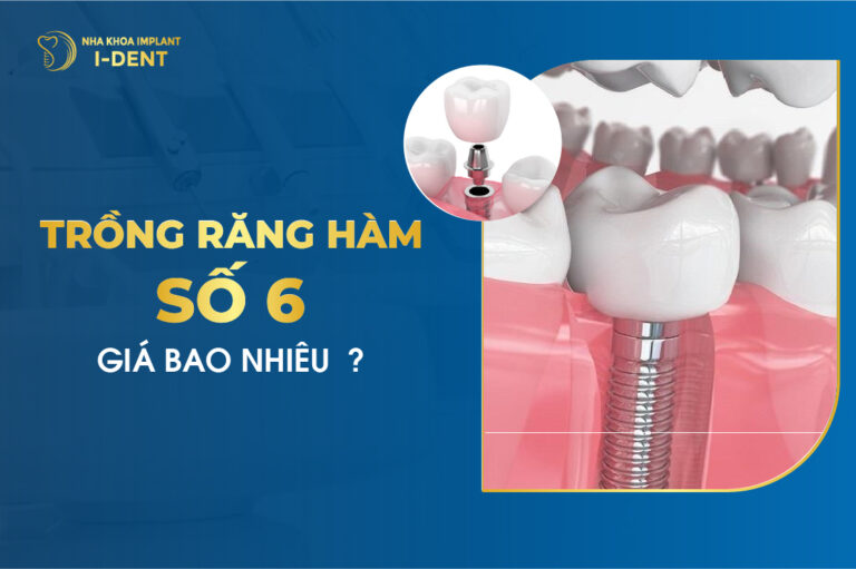 Trồng Răng Hàm Số 6 Giá Bao Nhiêu