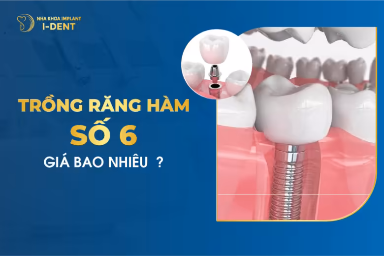 Trồng Răng Hàm Số 6 Giá Bao Nhiêu