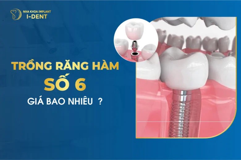 Trồng Răng Hàm Số 6 Giá Bao Nhiêu