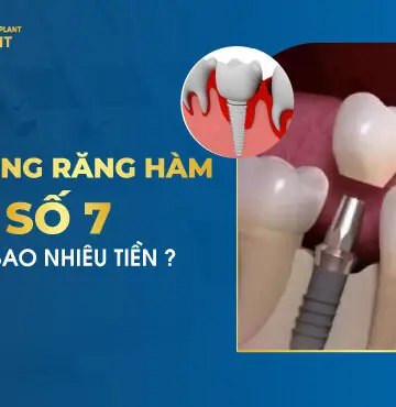 Trồng Răng Hàm Số 7 Giá Bao Nhiêu Tiền?