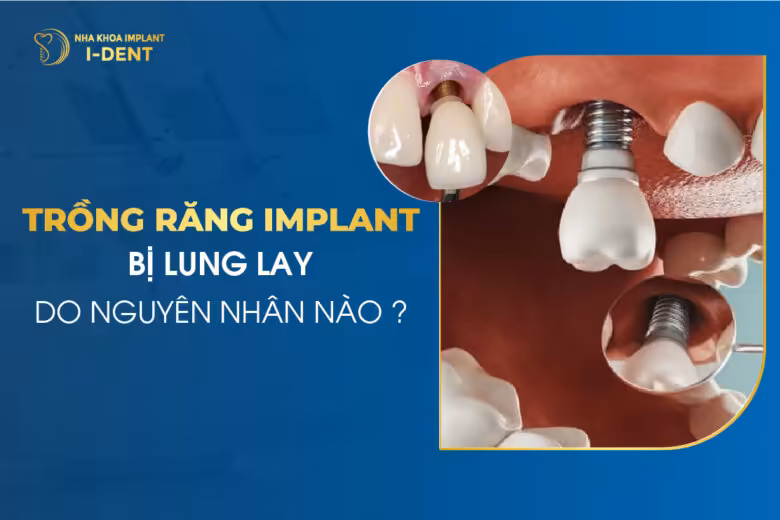 Trồng Răng Implant Bị Lung Lay Do Nguyên Nhân Nào