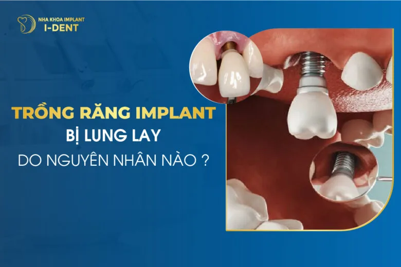 Trồng Răng Implant Bị Lung Lay Do Nguyên Nhân Nào