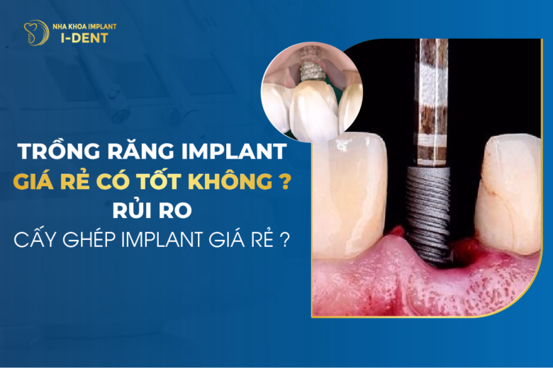 Trồng Răng Implant Giá Rẻ Có Tốt Không? Rủi Ro Cấy Ghép Implant Giá Rẻ