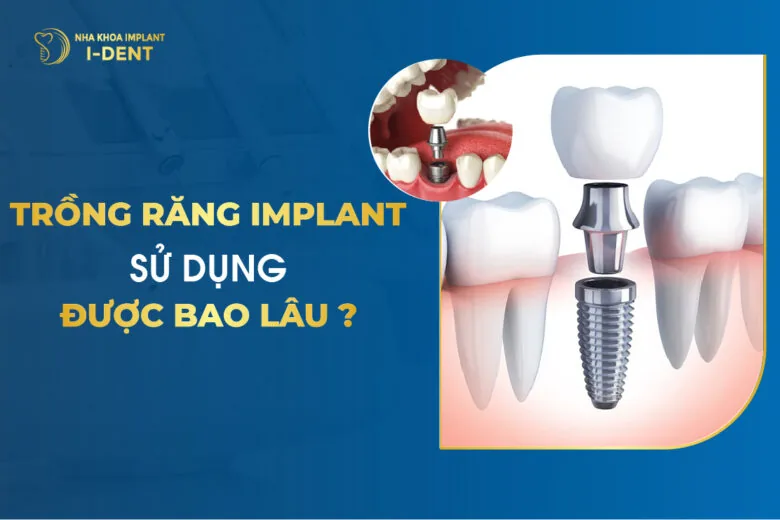 trồng răng implant được bao lâu