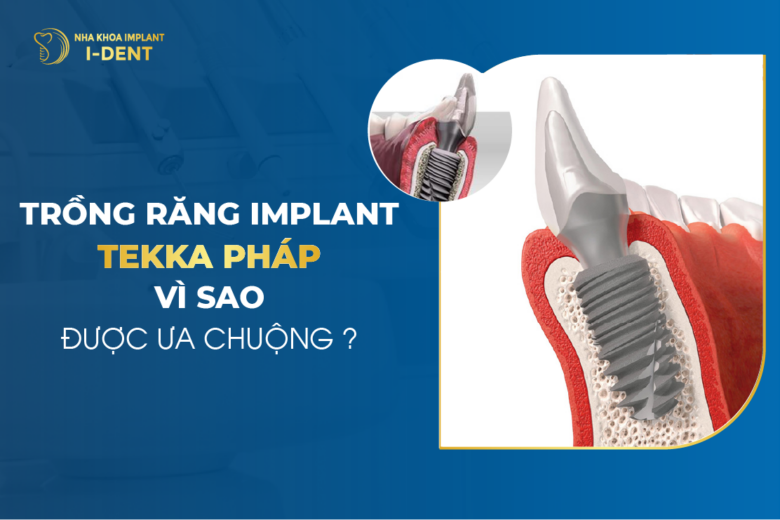 Trồng Răng Implant Tekka Pháp Vì Sao Được Ưa Chuộng?