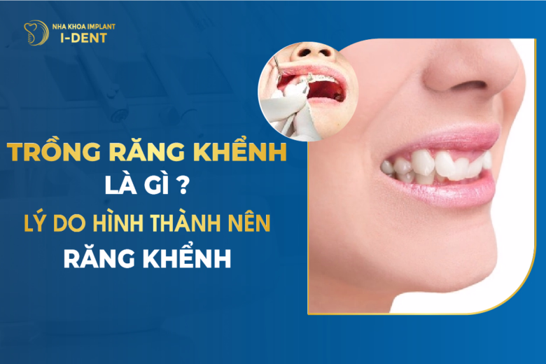 Trồng Răng Khểnh Là Gì Lý Do Hình Thành Nên Răng Khểnh