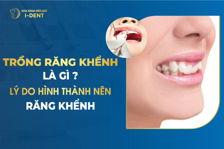 Trồng Răng Khểnh Là Gì? Lý Do Hình Thành Nên Răng Khểnh