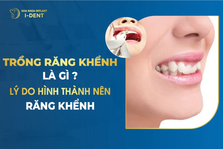 Trồng Răng Khểnh Là Gì Lý Do Hình Thành Nên Răng Khểnh