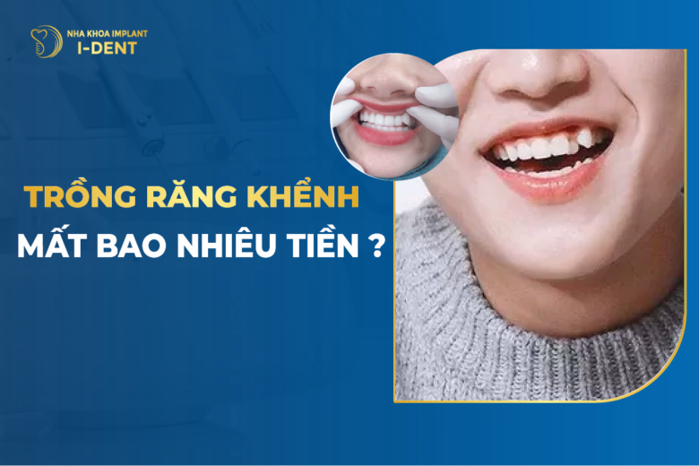 Trồng Răng Khểnh Mất Bao Nhiêu Tiền