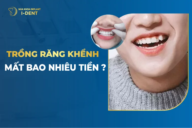 Trồng Răng Khểnh Mất Bao Nhiêu Tiền