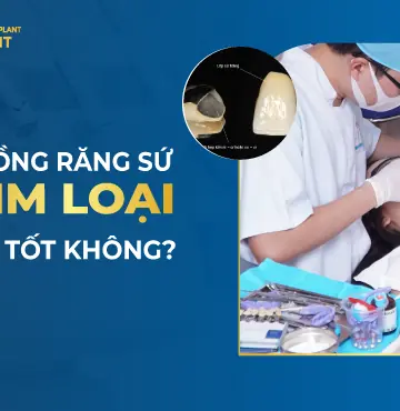 Răng Sứ Kim Loại Là Gì? Có Mấy Loại? Ưu Nhược Điểm