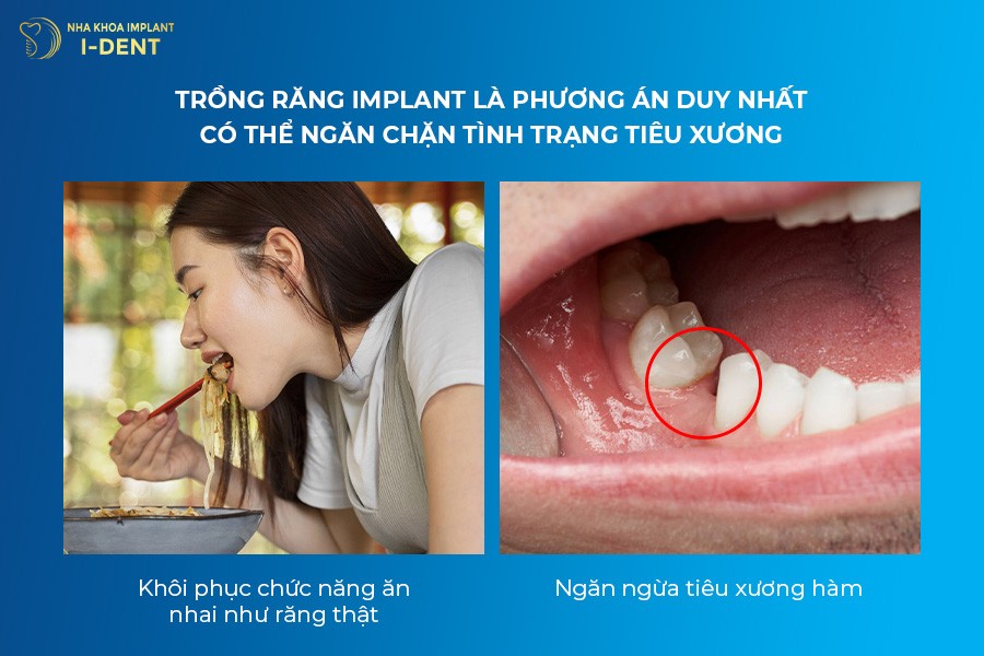 trồng răng implant là gì