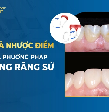 Ưu Và Nhược Điểm Của Phương Pháp Tráng Răng Sứ