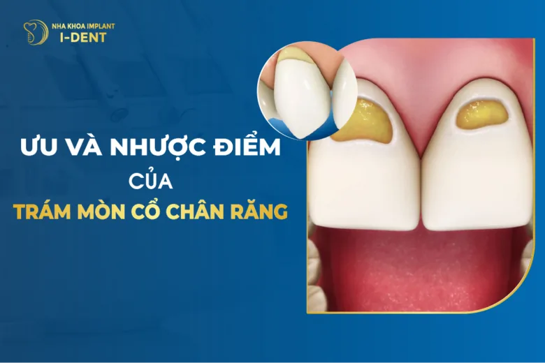 Ưu Và Nhược Điểm Của Trám Mòn Cổ Chân Răng