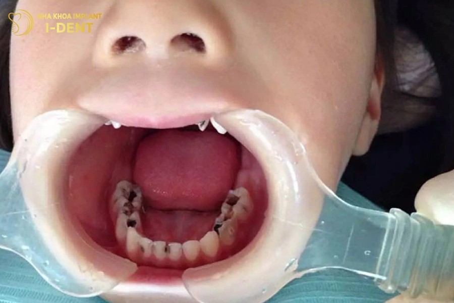 Vệ sinh răng miệng kém là nguyên nhân hàng đầu gây sâu răng