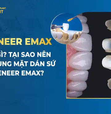 Veneer Emax Là Gì- Tại Sao Nên Sử Dụng Mặt Dán Sứ Veneer Emax-