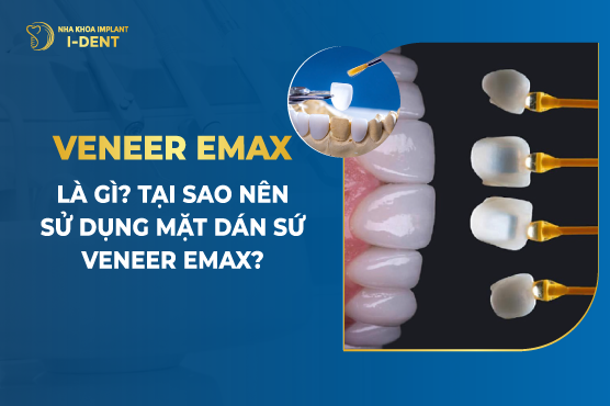 Răng sứ veneer emax có ưu điểm và tính năng gì?