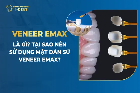 Veneer Emax Là Gì- Tại Sao Nên Sử Dụng Mặt Dán Sứ Veneer Emax-