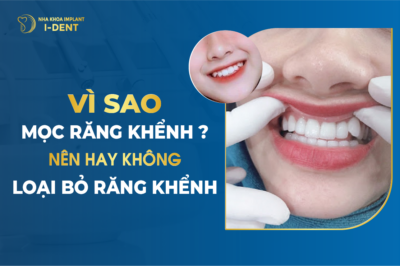 Vì Sao Mọc Răng Khểnh Nên Hay Không Loại Bỏ Răng Khểnh