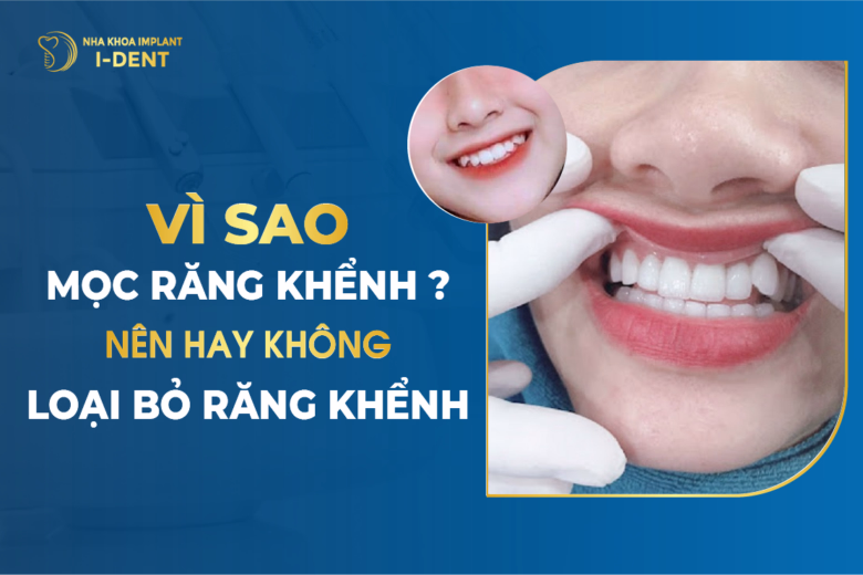 Vì Sao Mọc Răng Khểnh Nên Hay Không Loại Bỏ Răng Khểnh