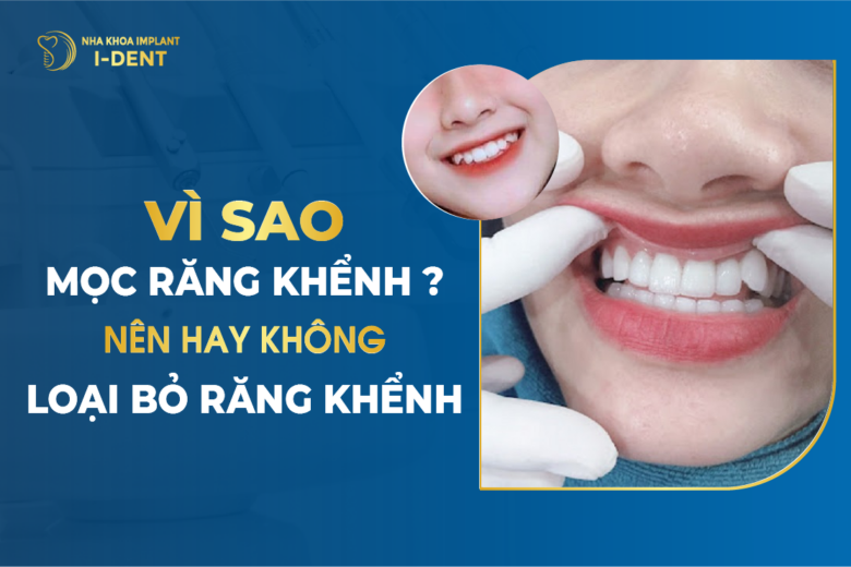 Vì Sao Mọc Răng Khểnh? Nên Hay Không Loại Bỏ Răng Khểnh