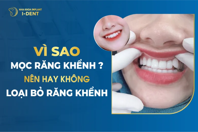 Vì Sao Mọc Răng Khểnh Nên Hay Không Loại Bỏ Răng Khểnh