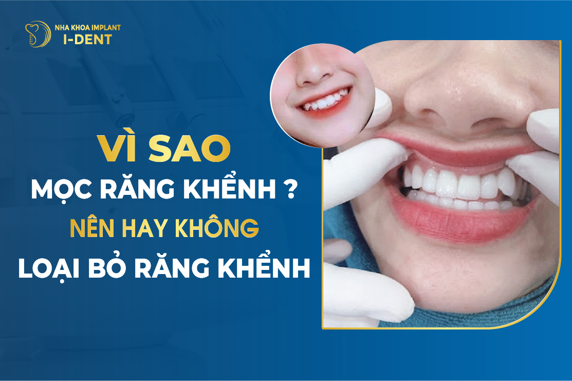 Sự mọc lệch của răng khểnh có ảnh hưởng đến sức khỏe răng miệng không?
