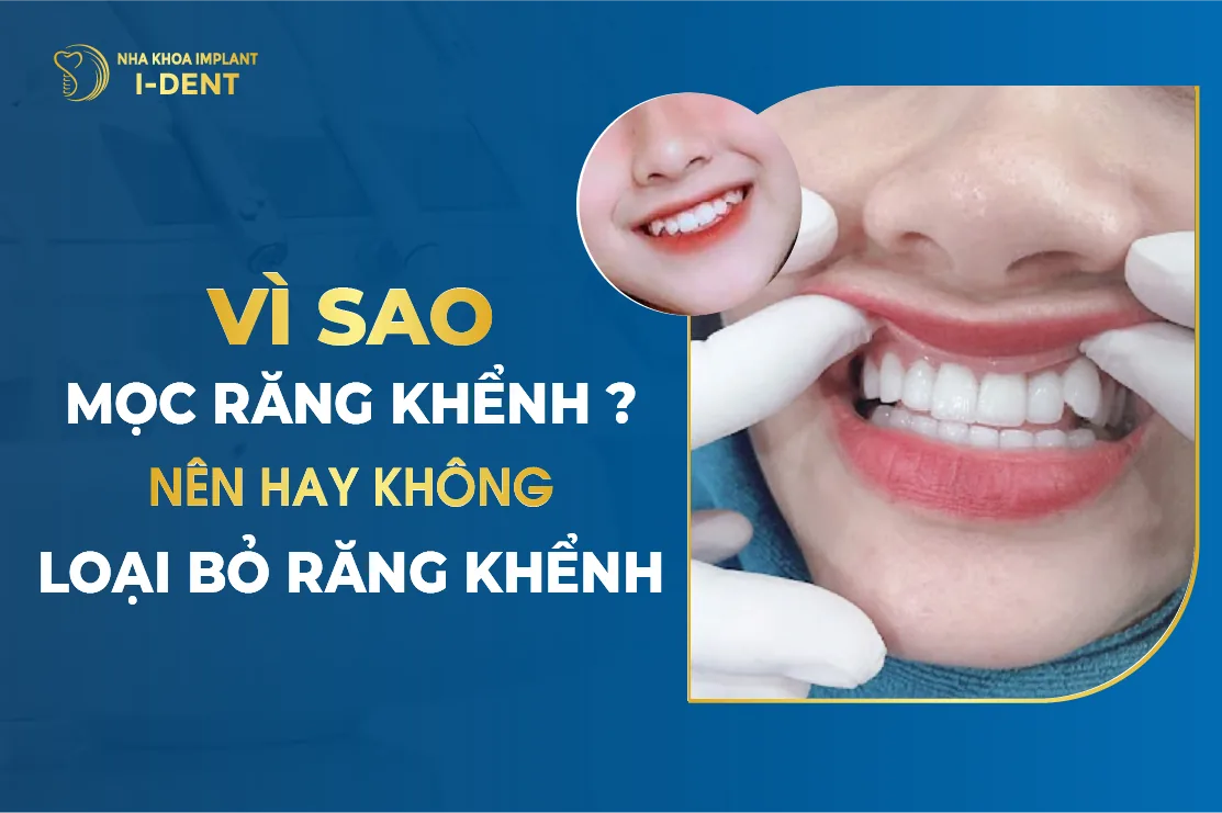 Vì Sao Mọc Răng Khểnh Nên Hay Không Loại Bỏ Răng Khểnh