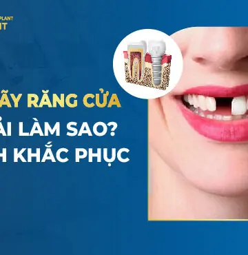 Bị Gãy Răng Cửa Phải Làm Sao? Cách Khắc Phục