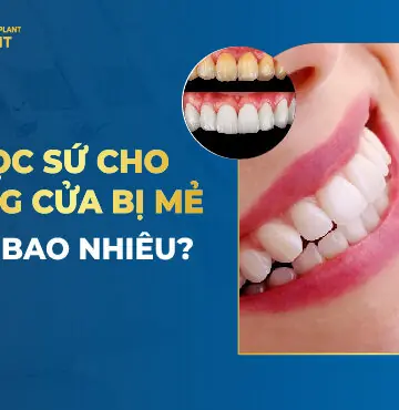 Bọc Sứ Cho Răng Cửa Bị Mẻ Giá Bao Nhiêu?