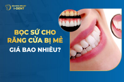 Bọc Sứ Cho Răng Cửa Bị Mẻ Giá Bao Nhiêu?