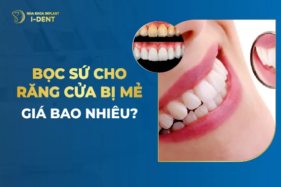 Bọc Sứ Cho Răng Cửa Bị Mẻ Giá Bao Nhiêu?