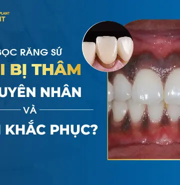 Bọc Răng Sứ Lợi Bị Thâm Nguyên Nhân Và Cách Khắc Phục?