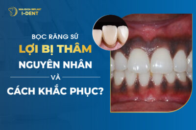 Bọc Răng Sứ Lợi Bị Thâm Nguyên Nhân Và Cách Khắc Phục?