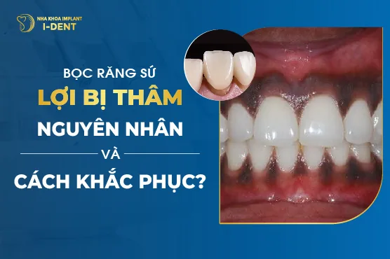 Bọc Răng Sứ Lợi Bị Thâm Nguyên Nhân Và Cách Khắc Phục?