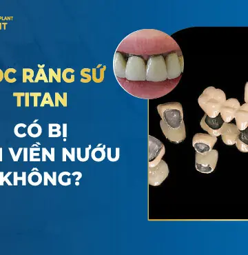 Bọc Răng Sứ Titan Có Bị Đen Viền Nướu Không?