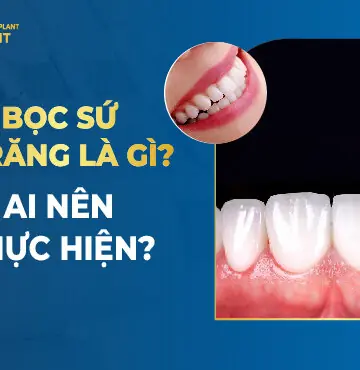 Bọc Sứ 16 Răng Là Gì? Ai Nên Thực Hiện?