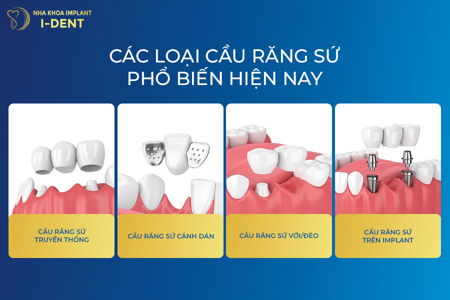 Các loại cầu răng sứ phổ biến hiện nay làm cầu răng sứ