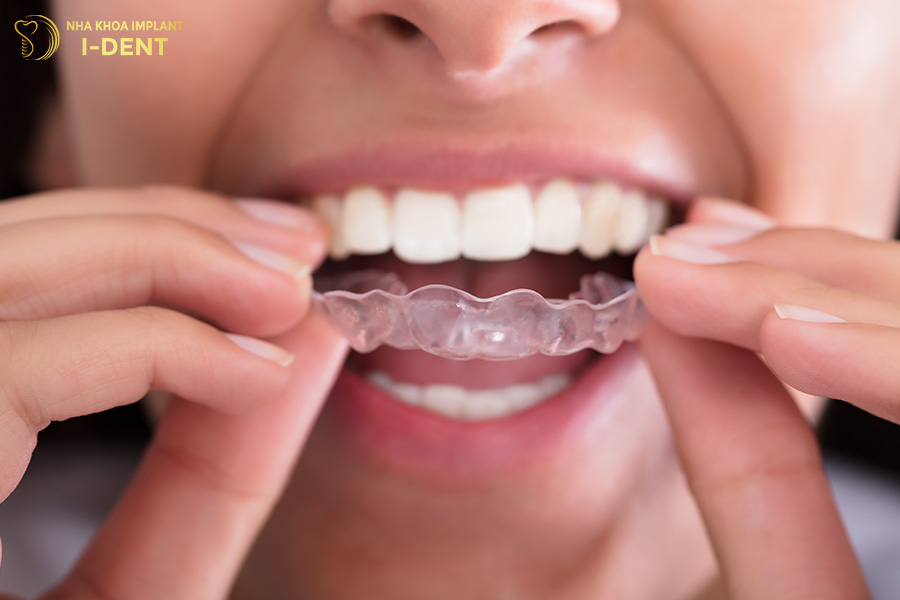 Nên dùng máng bảo vệ răng để bảo vệ răng sứ
