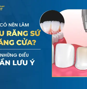 Có Nên Làm Cầu Răng Sứ Răng Cửa? Những Điều Cần Lưu Ý