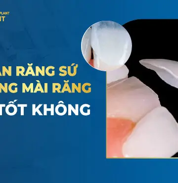 Dán Sứ Không Mài Răng Là Gì? Ưu Nhược Điểm? Giá Bao Nhiêu?