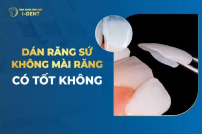 Dán Sứ Không Mài Răng Là Gì? Ưu Nhược Điểm? Giá Bao Nhiêu?